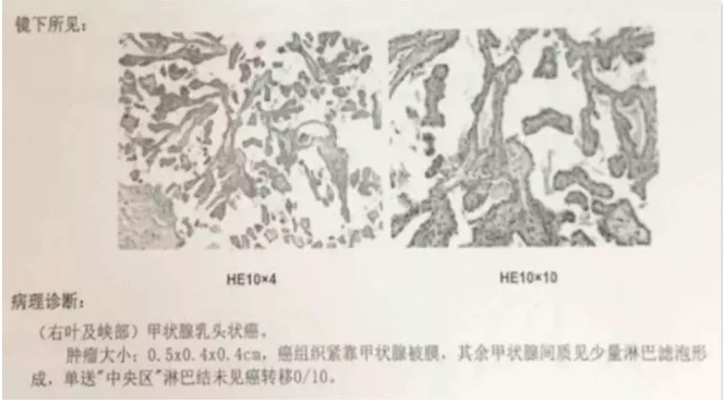 別慌，甲狀腺疾病還可以這樣投保！