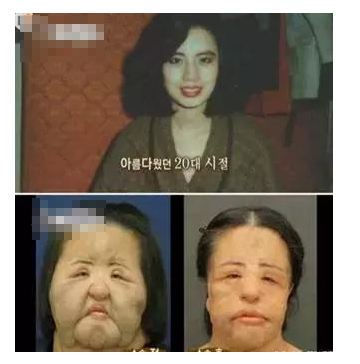 整容發(fā)生意外保險(xiǎn)賠嗎？